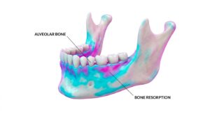 치조골의 해부학적 구조와 골 손실 부위의 3D 시각화 분석 이미지