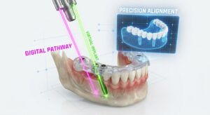 3D 디지털 가이드를 활용한 임플란트 식립 경로 계획 시뮬레이션